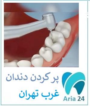 بهترین دندانپزشک برای پر کردن دندان در غرب تهران دکتر سید محسنی 